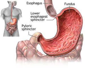 Penyakit Gastritis Akut, Penyebab dan Gejalanya